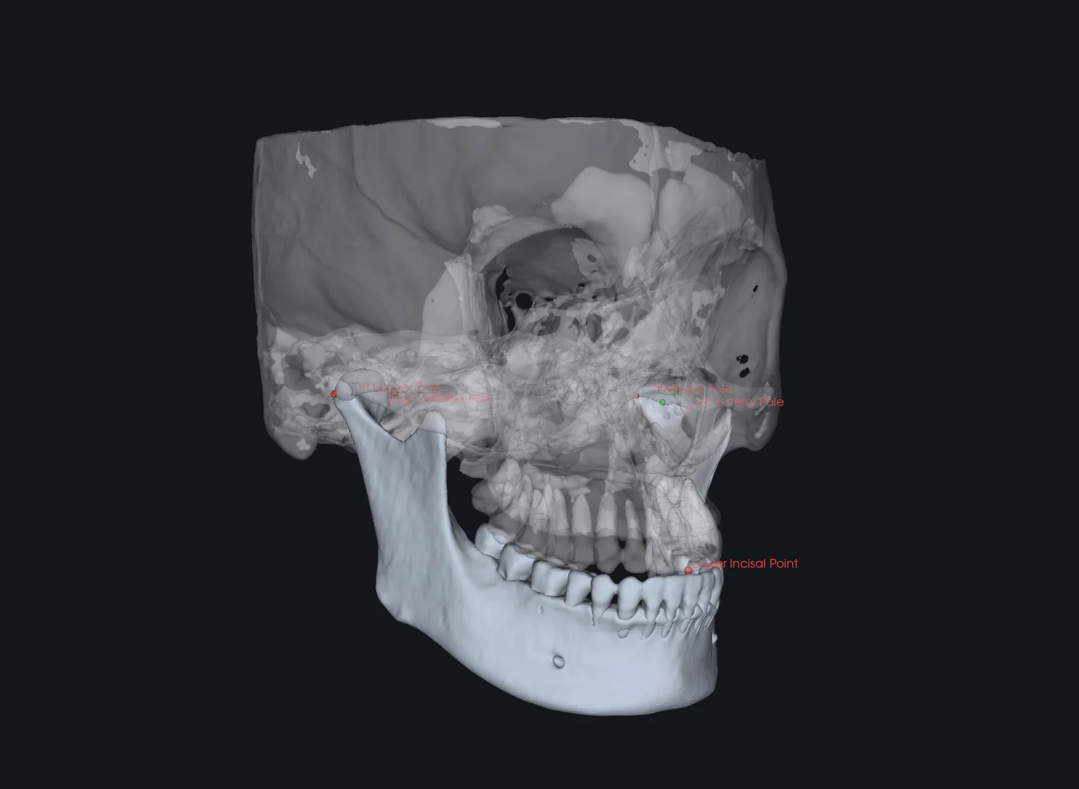 CondyleLocator three-dimensional CBCT and dental model registration with condylar and incisal reference points